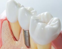 Dental Implants