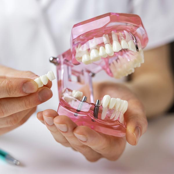 dental implant