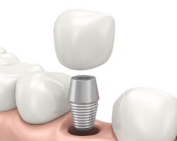 Dental implants