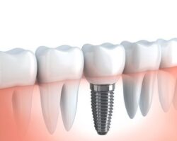 Dental implants