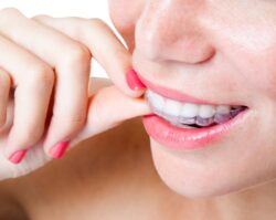 A Women putting her aligners